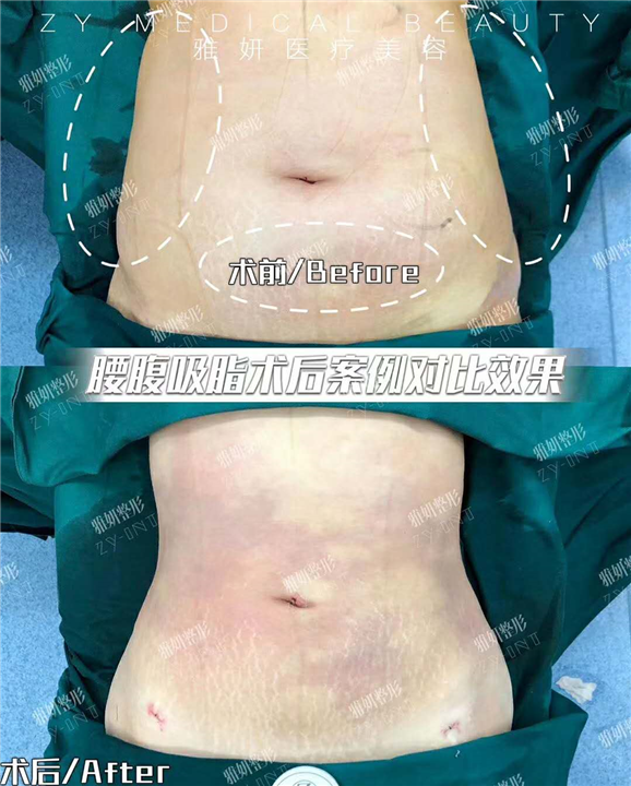 广州腰腹吸脂费用 