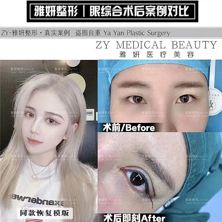 雅妍眼综合整形多少钱 