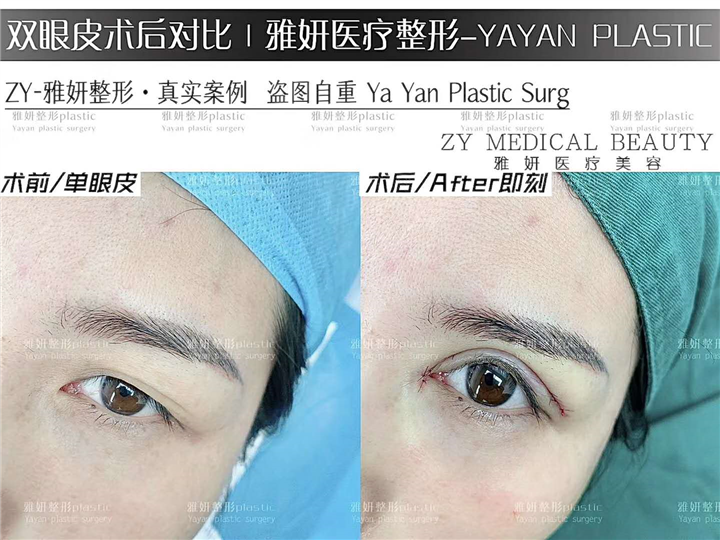 广州雅妍双眼皮价格 
