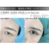 广州雅妍双眼皮价格 