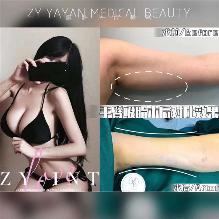 广州手臂吸脂价格 