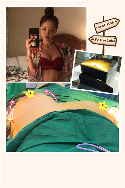 雅妍假体隆胸整形多少钱 