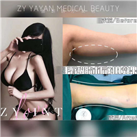 广州手臂吸脂价格 