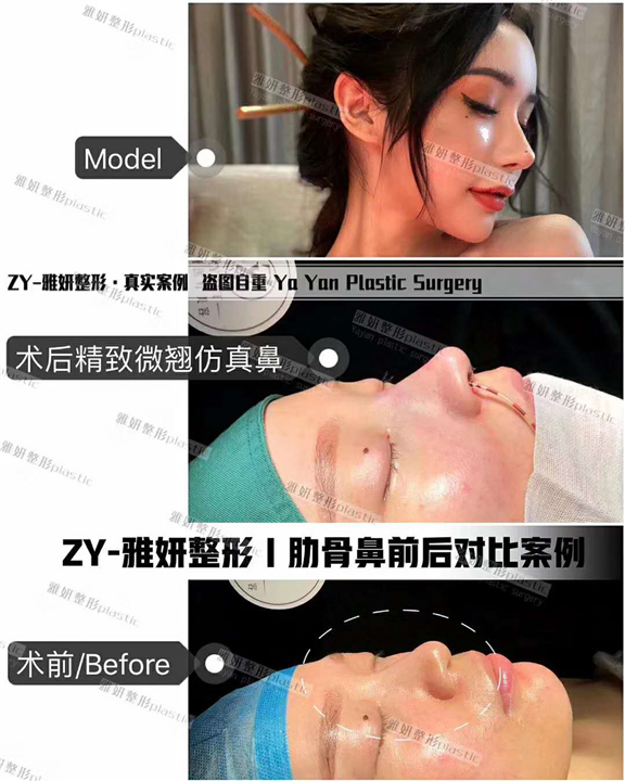 广州雅妍肋骨鼻整形价格 