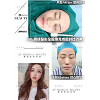 雅妍全脸脂肪填充价格 