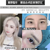 雅妍整形眼综合多少钱 
