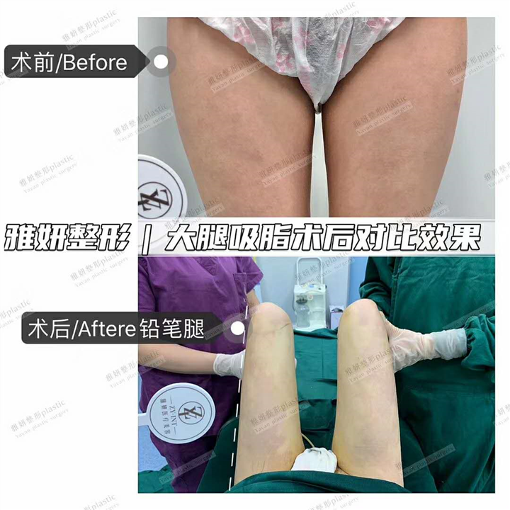 雅妍大腿吸脂费用 