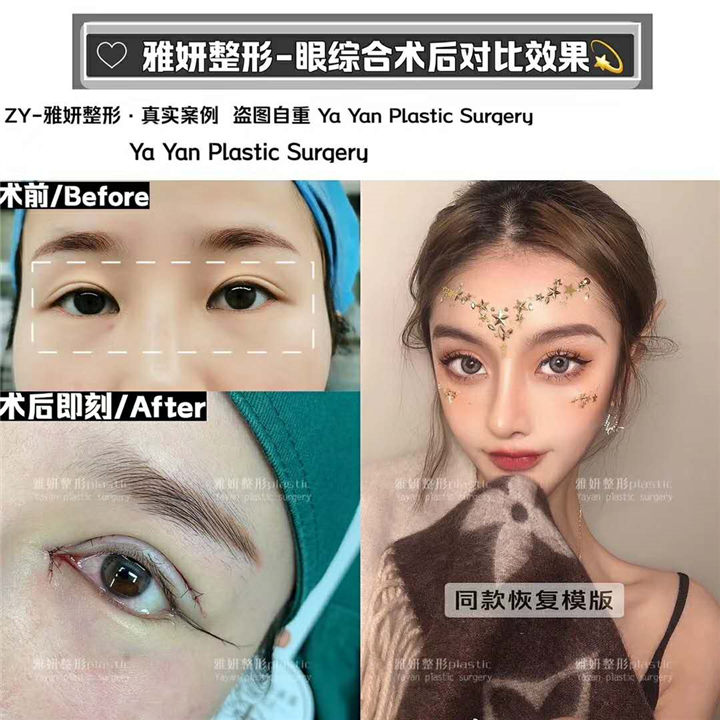 雅妍整形眼综合价格 