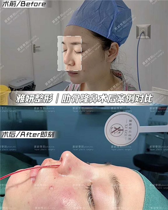 广州雅妍肋骨隆鼻整形 