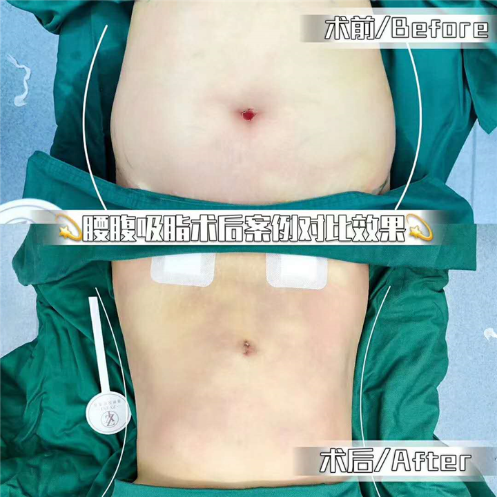 广州腰腹吸脂价格 
