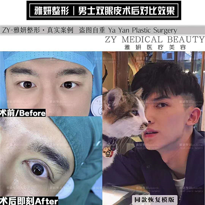 雅妍男士双眼皮价格 