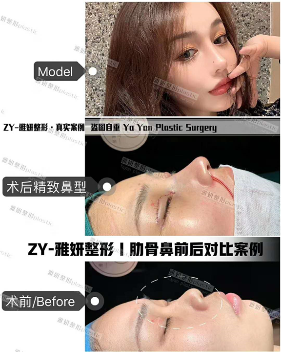 雅妍整形肋骨鼻价格 
