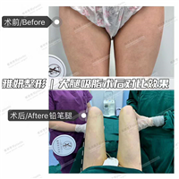 雅妍大腿吸脂费用 