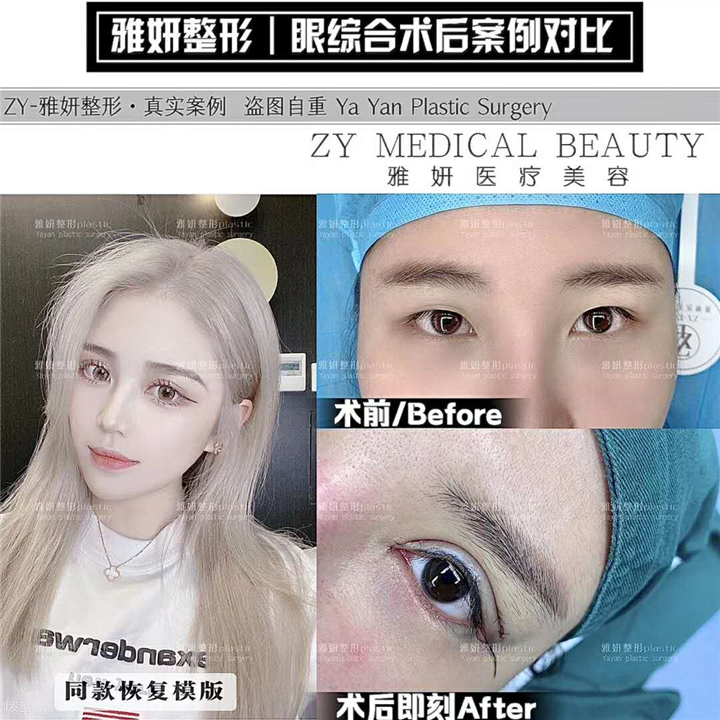 雅妍整形眼综合多少钱 
