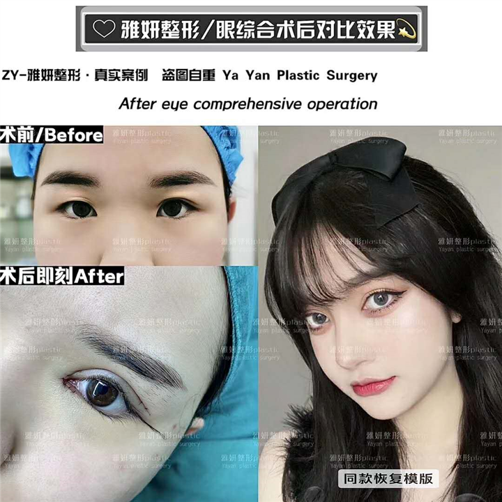 广州眼综合整形哪家好 