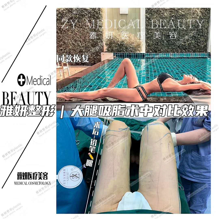 雅妍大腿吸脂整形 