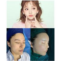 广州全脸脂肪填充价格 