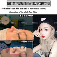 雅妍整形肋骨鼻多少钱 
