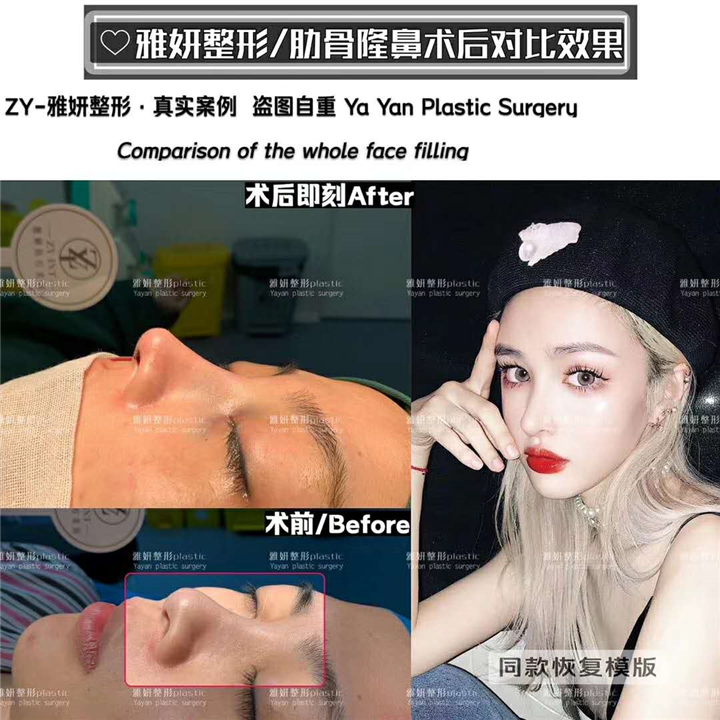 雅妍整形肋骨鼻多少钱 