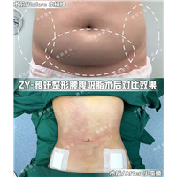 雅妍腰腹吸脂费用 