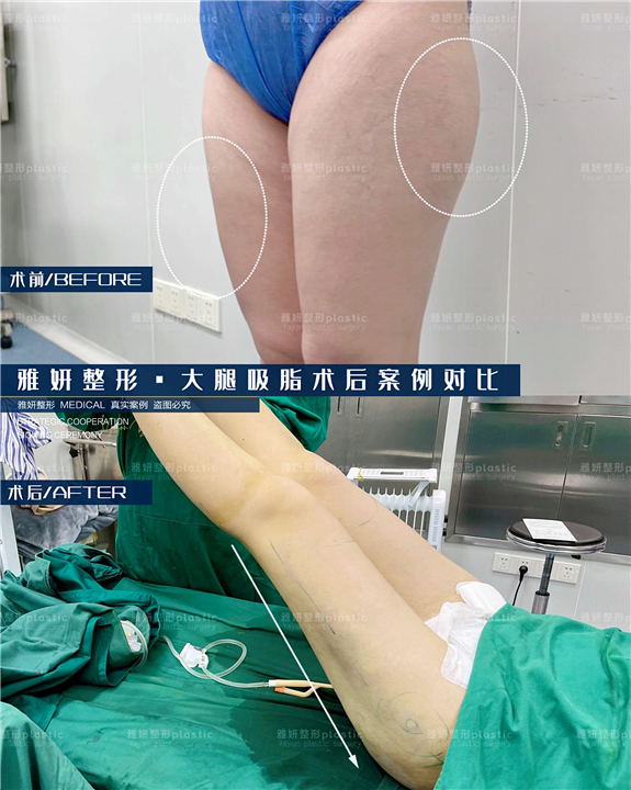 雅妍整形大腿吸脂价格
