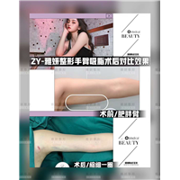 雅妍手臂吸脂价格 
