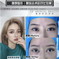 雅妍双眼皮整形价格 