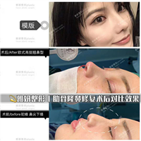 雅妍整形肋骨隆鼻修复 