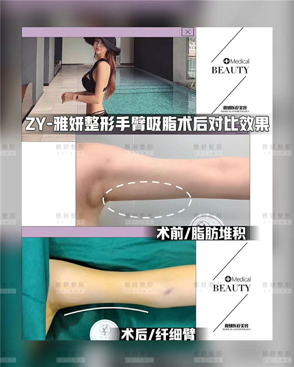 雅妍手臂吸脂多少钱 
