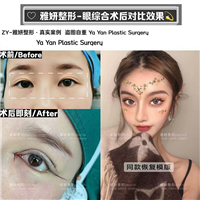 雅妍整形眼综合价格 