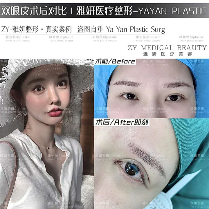 雅妍整形双眼皮多少钱 