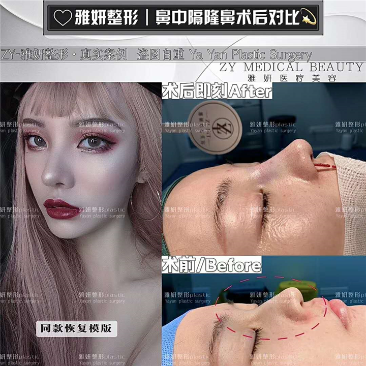 雅妍鼻中隔整形 
