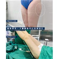 雅妍整形大腿吸脂价格