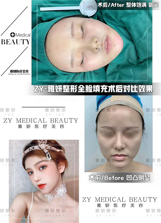 广州全脸脂肪填充多少钱 