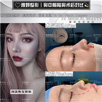 雅妍鼻中隔整形 