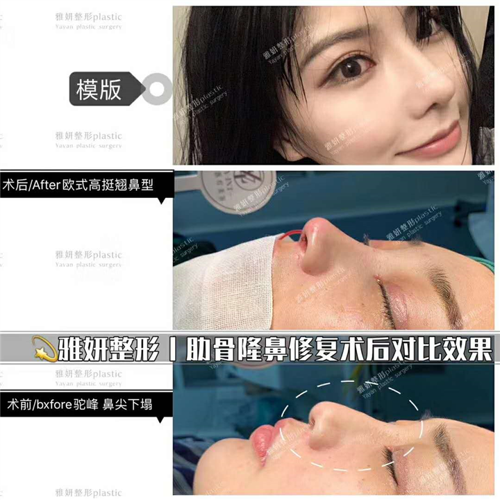 雅妍整形肋骨隆鼻修复 