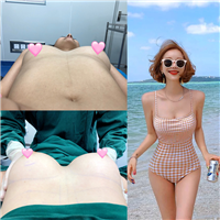 广州脂肪隆胸价格 