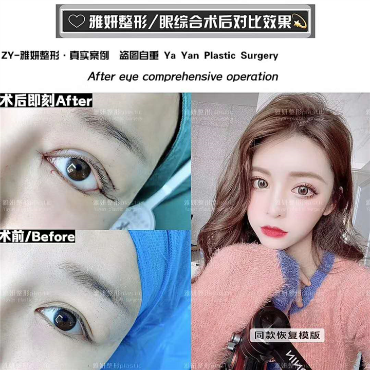 广州双眼皮整形 