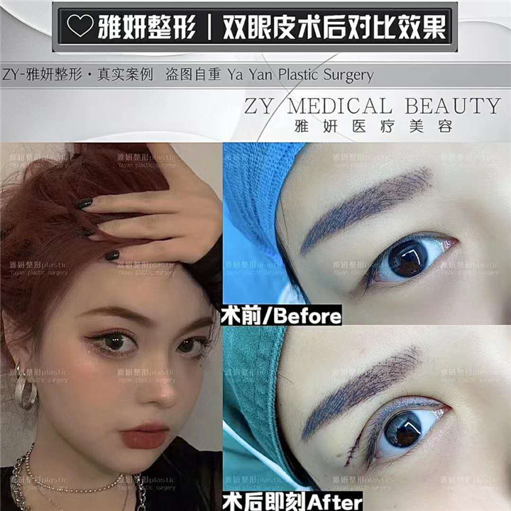雅妍双眼皮整形 