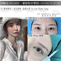 雅妍整形双眼皮多少钱 