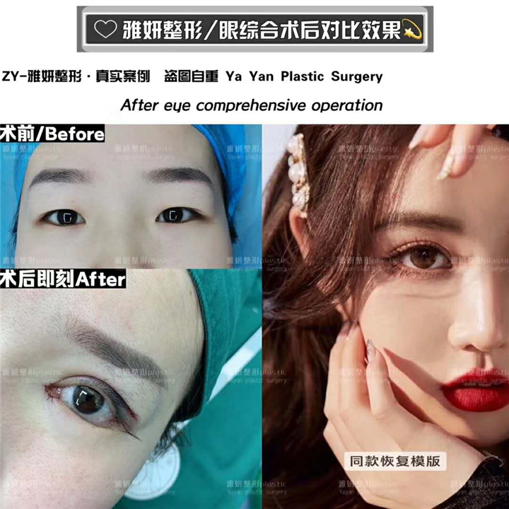 雅妍眼综合整形价格 