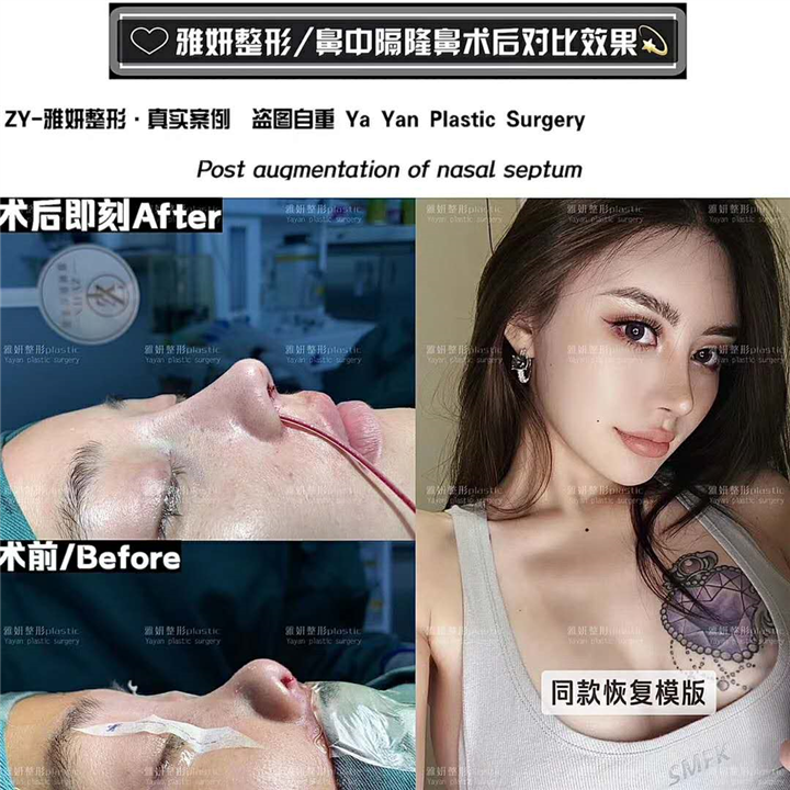 广州雅妍鼻中隔整形价格 