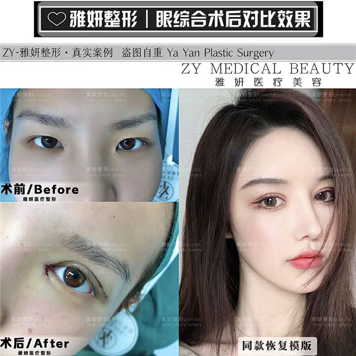广州眼综合整形价格 