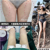 雅妍大腿吸脂价格 