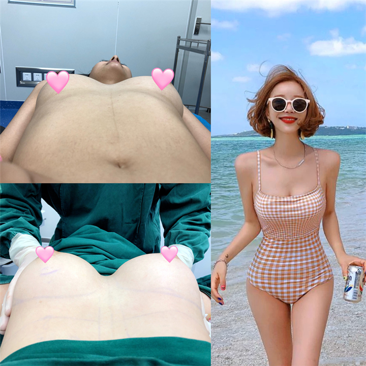 广州脂肪隆胸价格 