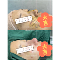 鼻综合术后护理分享