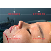 Doctor Yan's rhinoplasty case