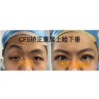 刘培林医生CFS矫正重度上睑下垂案例
