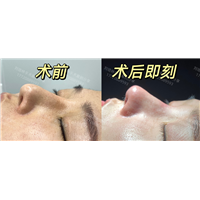 厦门刘培林医生修复鼻整形案例