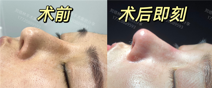 厦门刘培林医生修复鼻整形案例